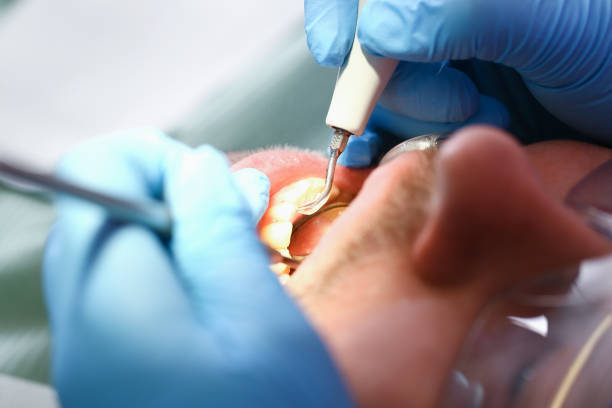 Best Emergency Dental Extractions in Taft, FL